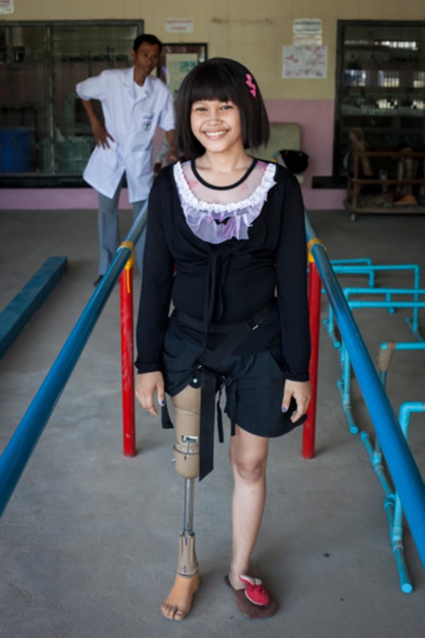 A Cambodian girl learns to walk with her new prosthesis in Kien Khleang Rehabilitation Center